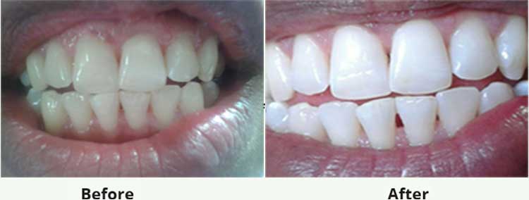 Teeth Whitening (Bleaching) service